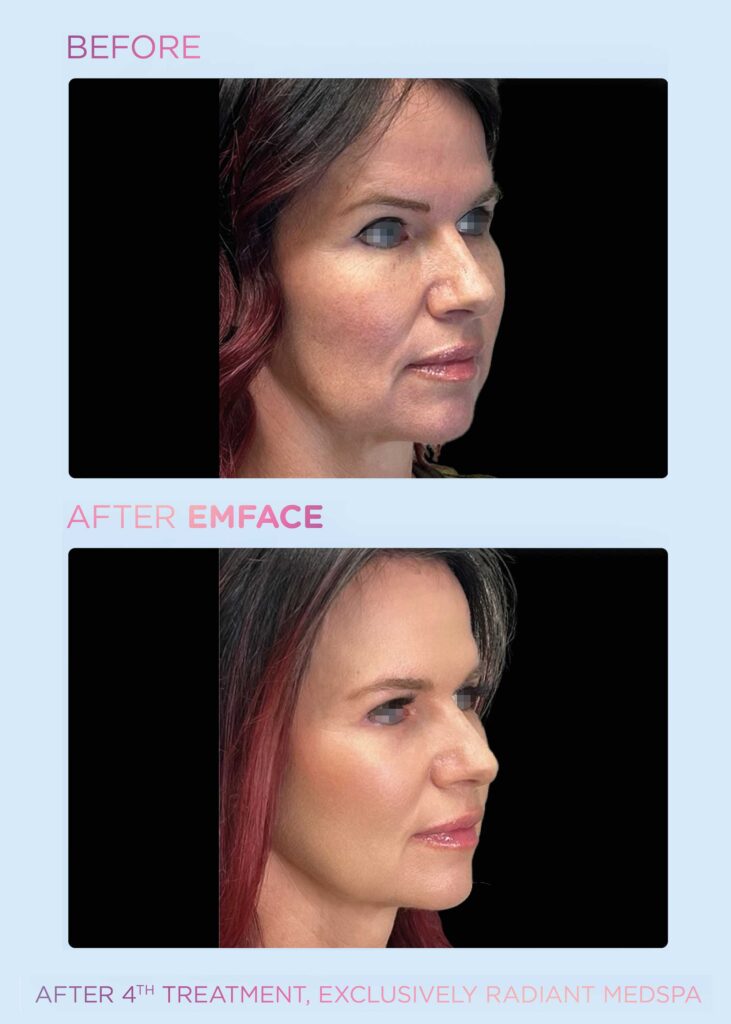 EMFace™, BTL Antes Depués